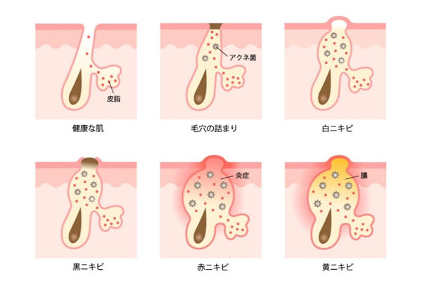 ニキビの種類