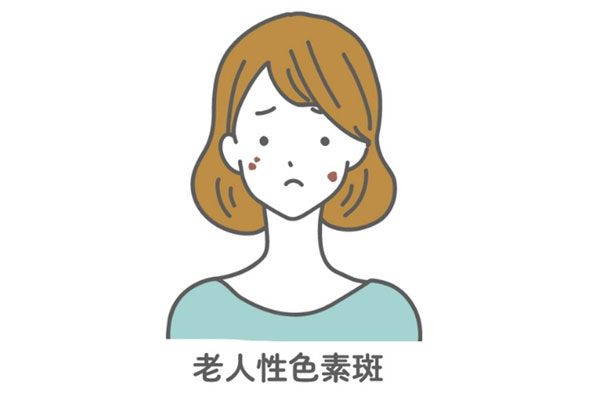 老人性色素斑（日光性色素斑）
