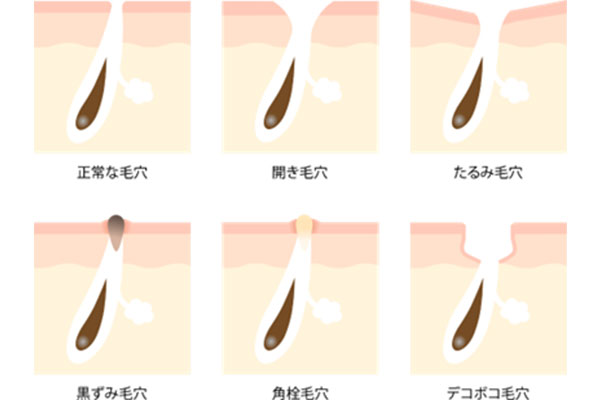 毛穴の開き（開き毛穴）が起こる原因