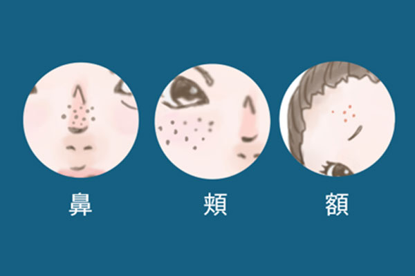 毛穴の開き（開き毛穴）ができる部位