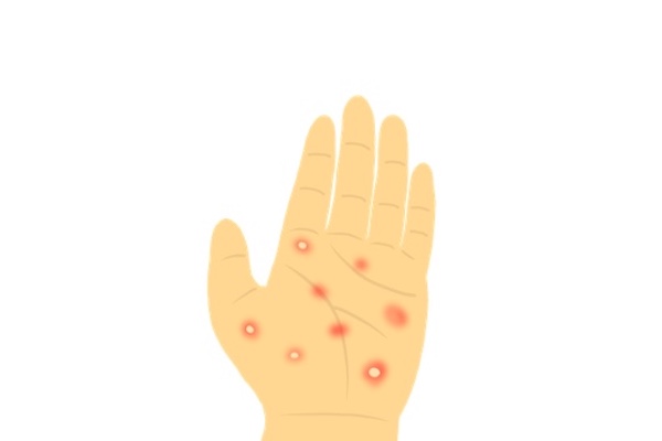 掌蹠膿疱症とは