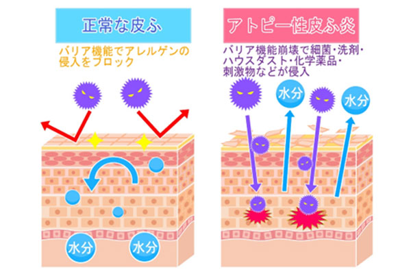 アトピー性皮膚炎とは