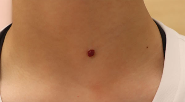 当院で行っている主な日帰り手術